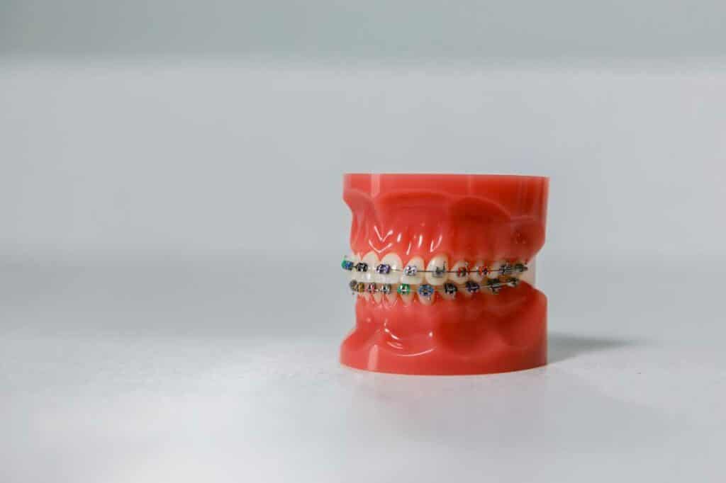traditional braces from Greg Brown Orthodontics