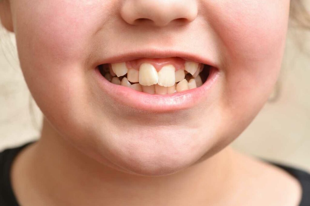 photo of a crooked teeth in children